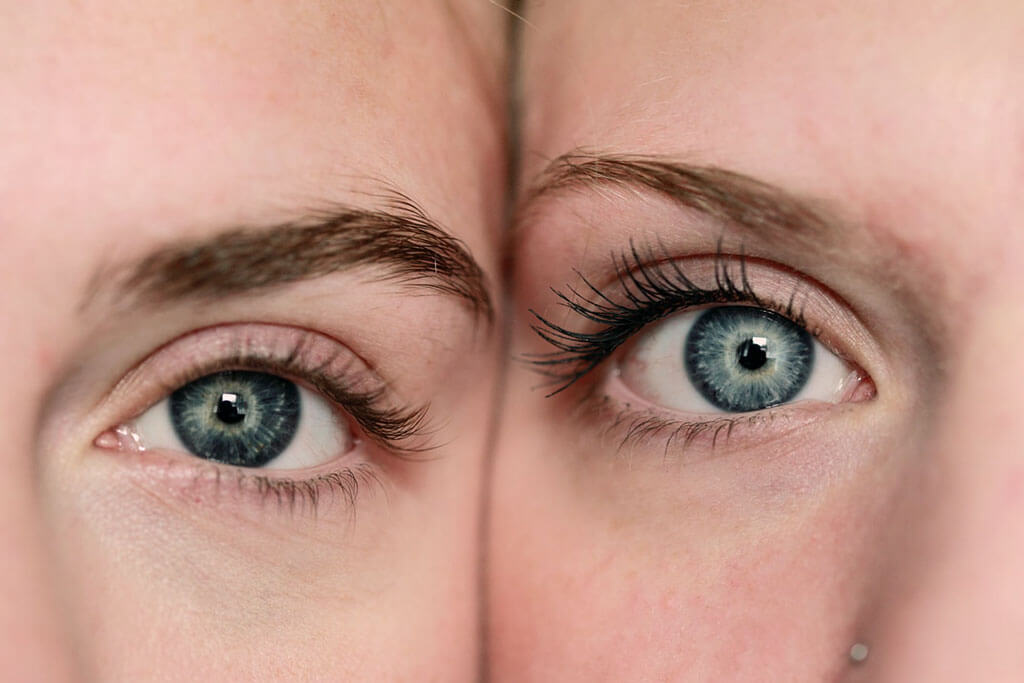 Weitsichtigkeit lasern lassen - (Hyperopie, Hypermetropie)