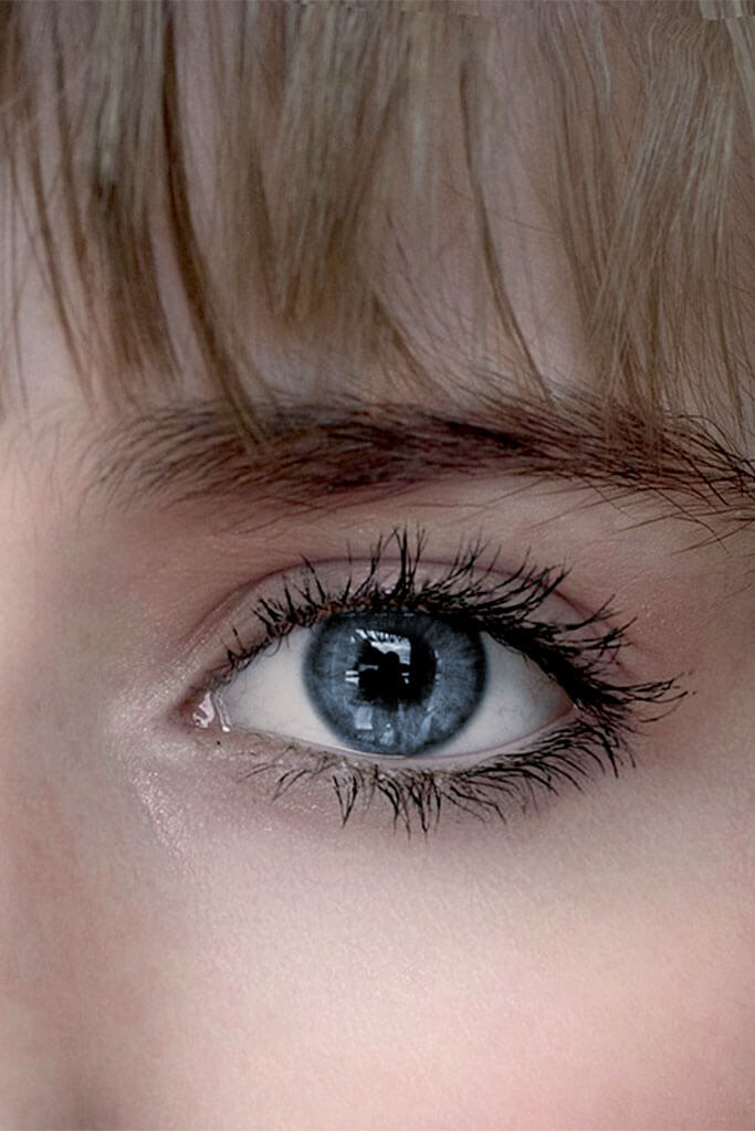 Die Glaukomoperation mit Goniotomie!