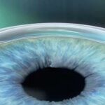 Das Augenlasern ist eine beliebte Alternative zur Brille, die schon vielen Menschen zu mehr Lebensqualität verholfen hat.