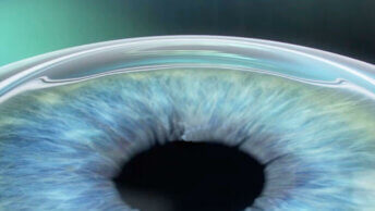 Das Augenlasern ist eine beliebte Alternative zur Brille, die schon vielen Menschen zu mehr Lebensqualität verholfen hat.