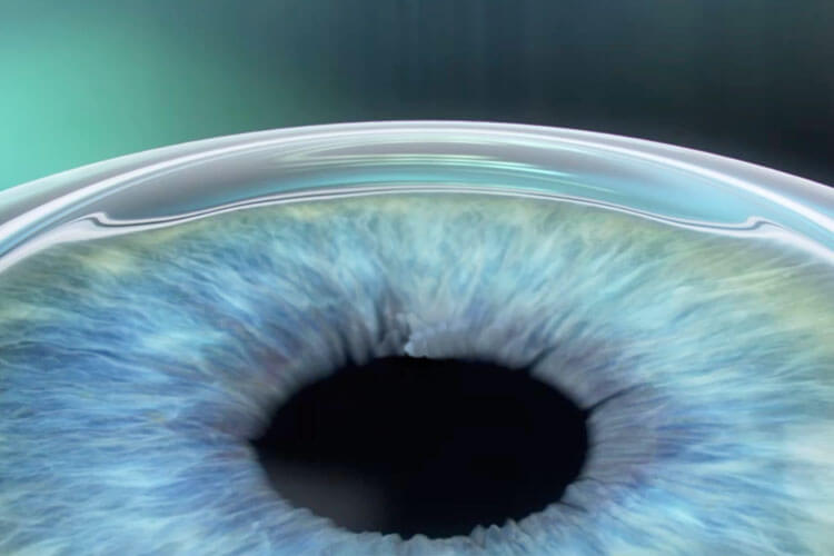 Das Augenlasern ist eine beliebte Alternative zur Brille, die schon vielen Menschen zu mehr Lebensqualität verholfen hat.