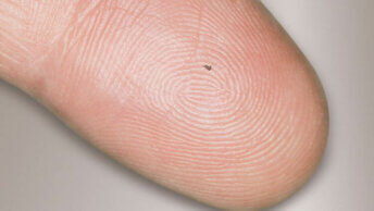 Mikroimplantat iStent die Revolution beim Gruenen Star