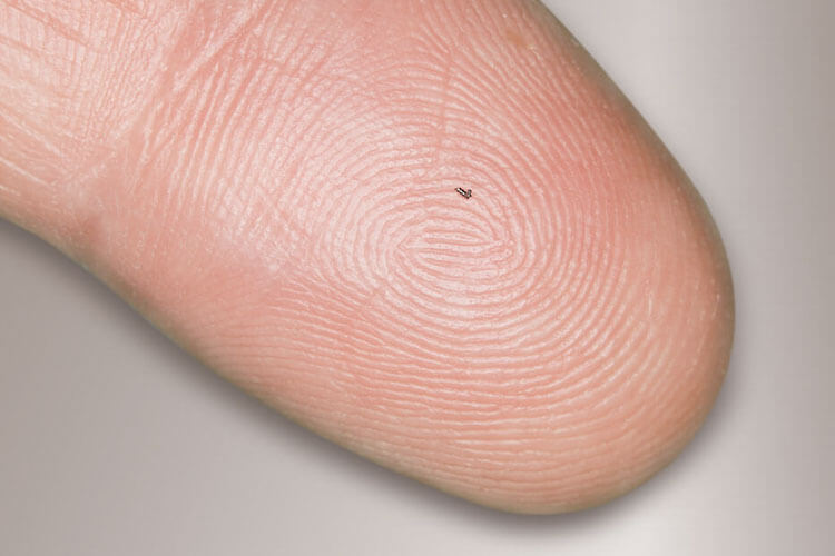 Mikroimplantat iStent die Revolution beim Gruenen Star