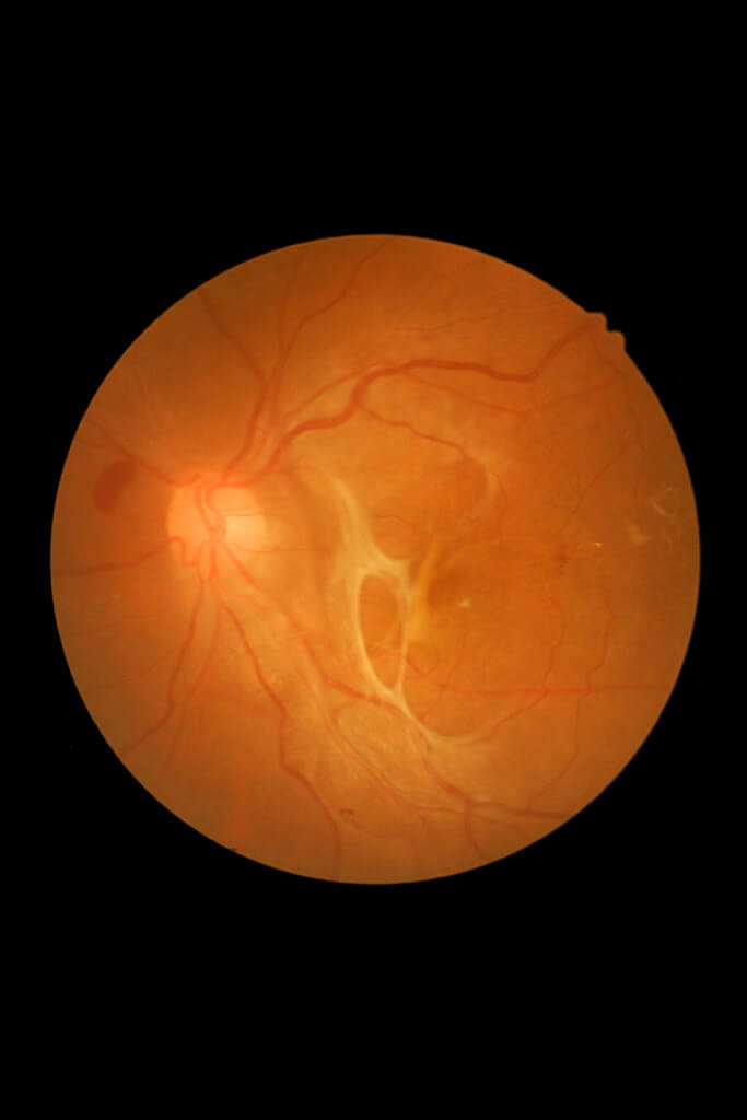 Was genau ist die Netzhautablösung (Ablatio retinae, Amotio retinae)?