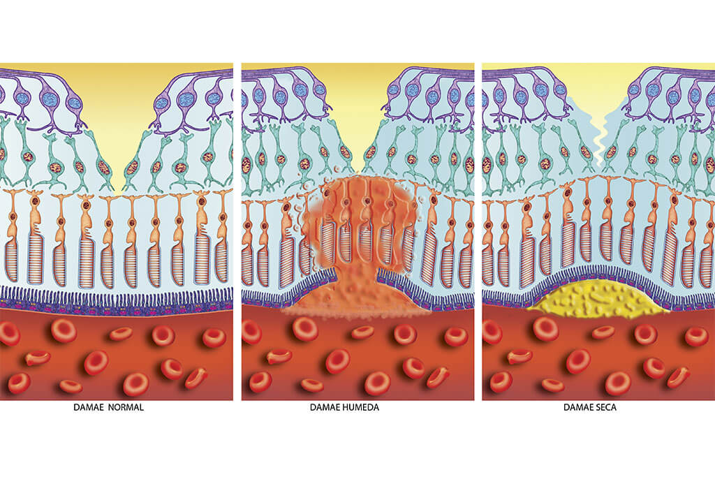 Unterschiede: Die trockene Makuladegeneration