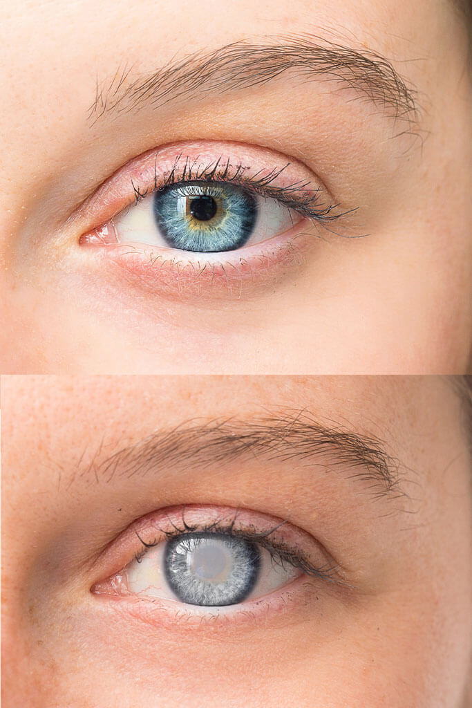 Grauer Star - Was ist die Augenerkrankung Katarakt?