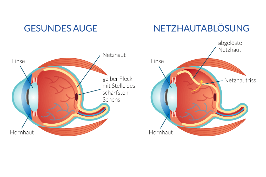 Was passiert bei der Ablösung der Netzhaut?