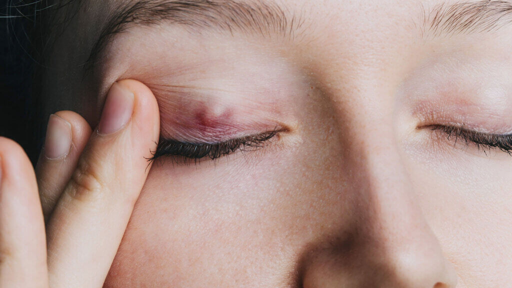 Gerstenkorn Symptome - wie erkenne ich die Entzündung