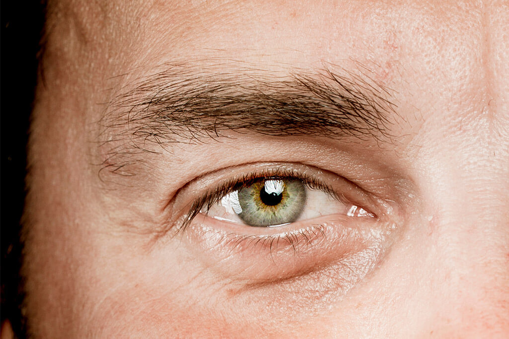 Monofokallinsen Implantat gegen Grauen Star