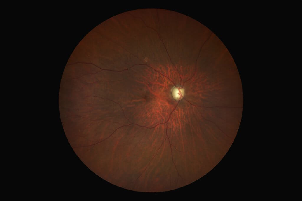 Grüner Star Normaldruckglaukom während Diagnose