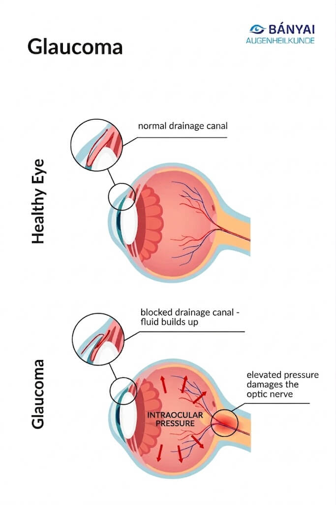 Graph and representation of glaucoma and healthy eye