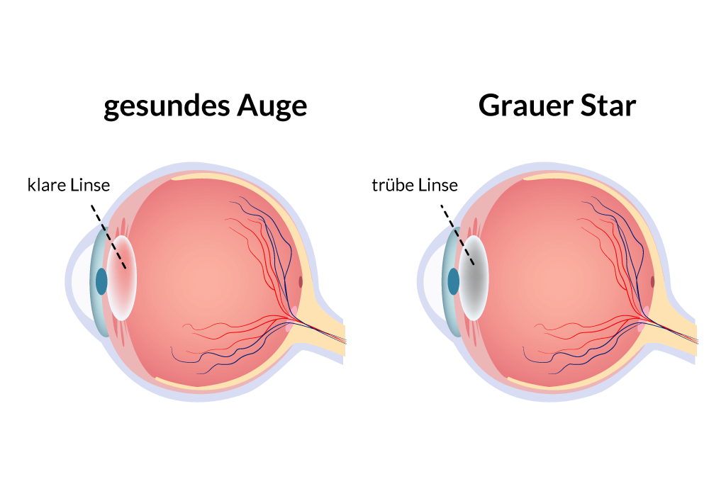 Vergleich: Gesundes Auge und Auge mit Grauer Star Erkrankung