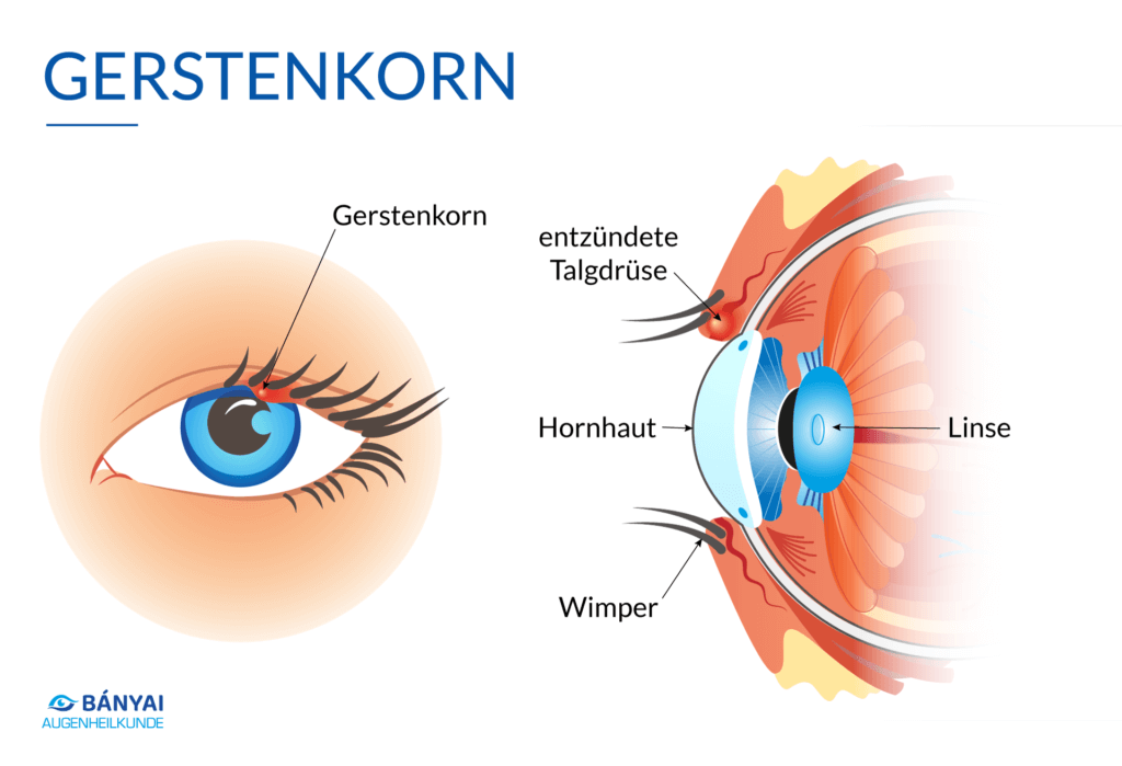 Gerstenkorn - Was ist ein Hordeolum? - Banyai Augenheilkunde - Gerstenkorn - Ursachen, Symptome und Behandlung