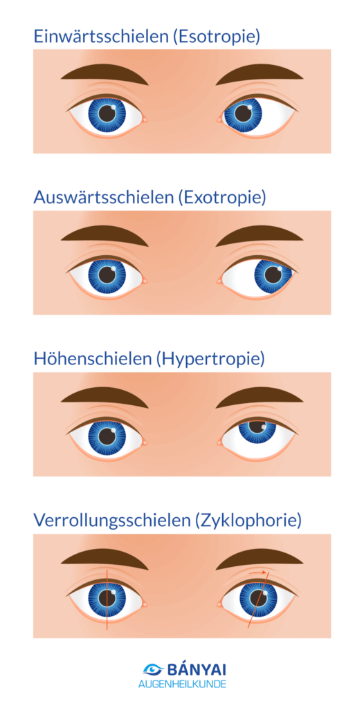 Formen des Schielen - Augenheilkunde Bányai Stuttgart