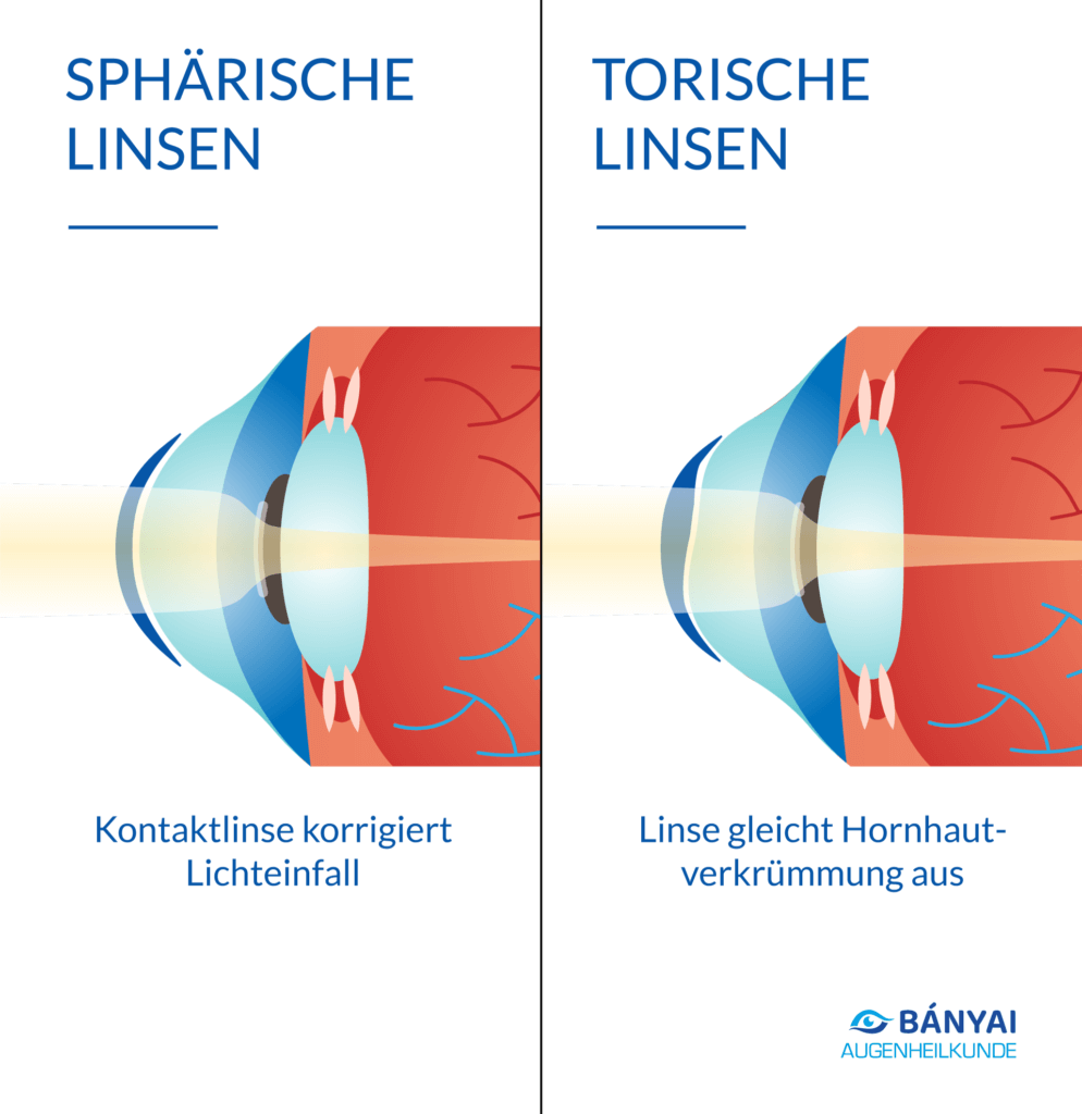 Sphärische Linsen und Torische Linsen im Vergleich