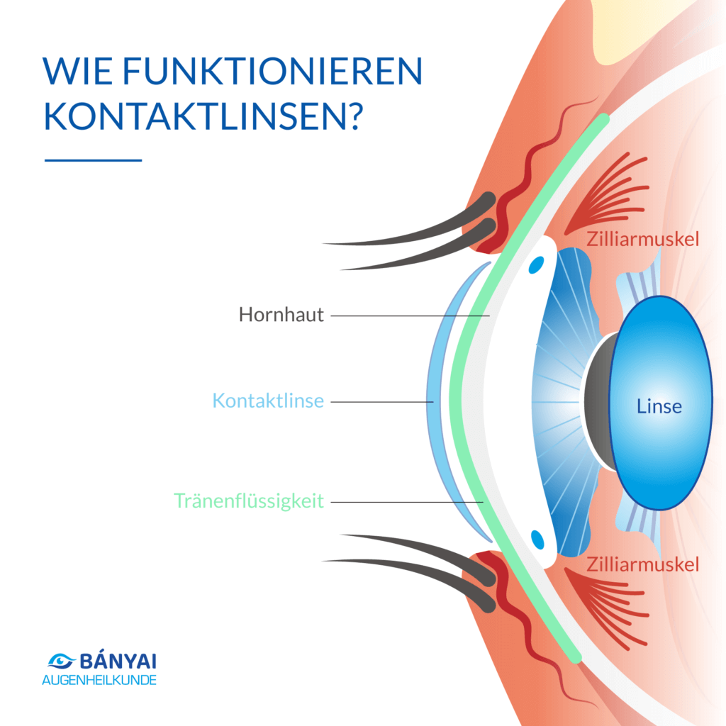Wie funktionieren Kontaktlinsen?
