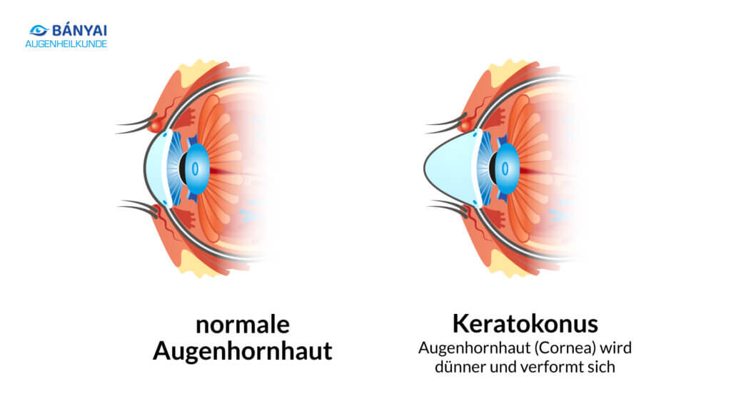 Was ist Keratokonus?