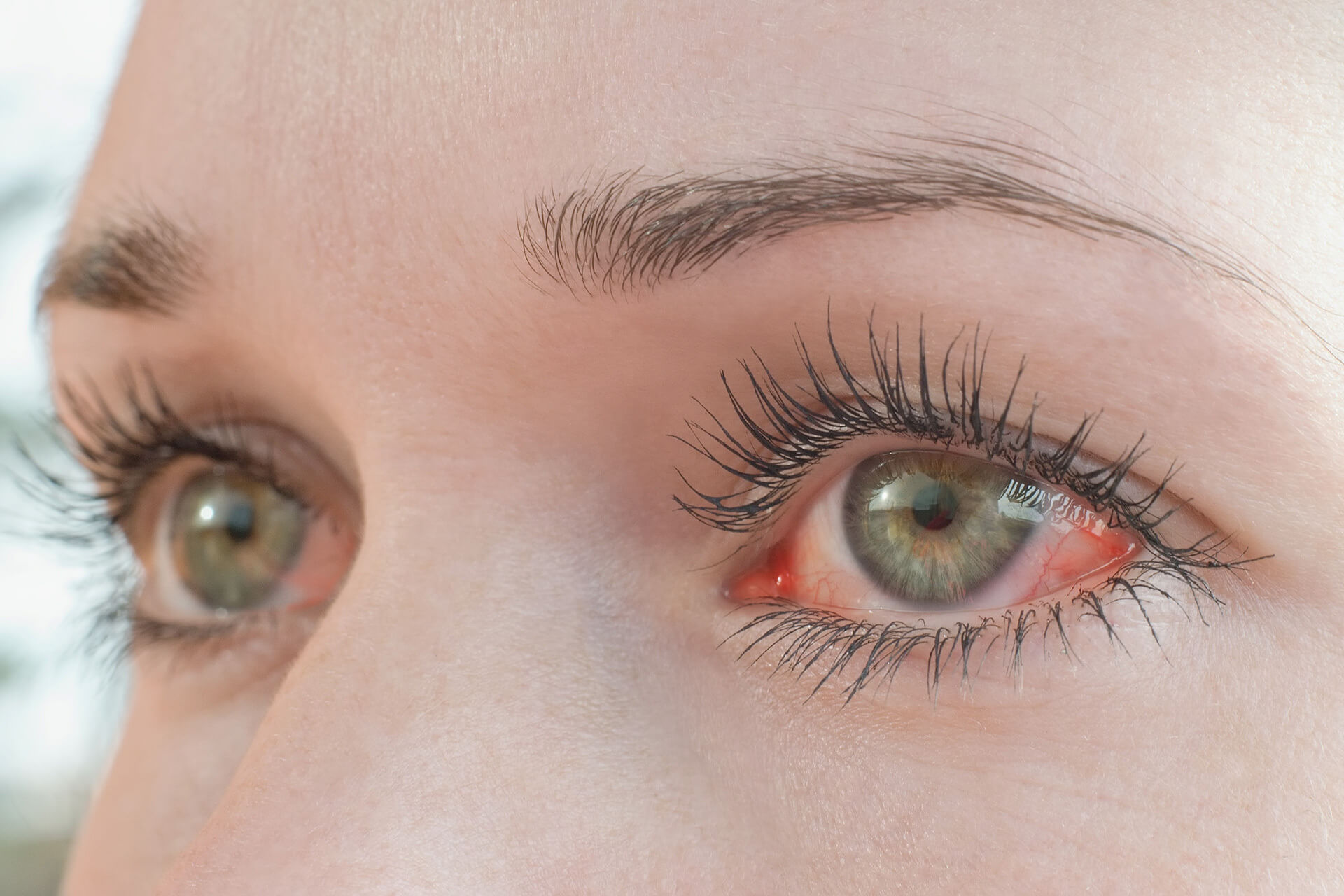 Augen jucken und brennen was tun bei einer Pollenallergie? Bányai Augenheilkunde