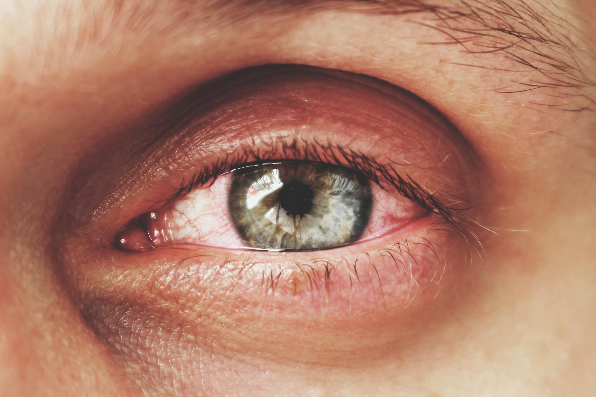 Augenerkrankungen: Entzündung der mittleren Augenhaut (Uveitis)
